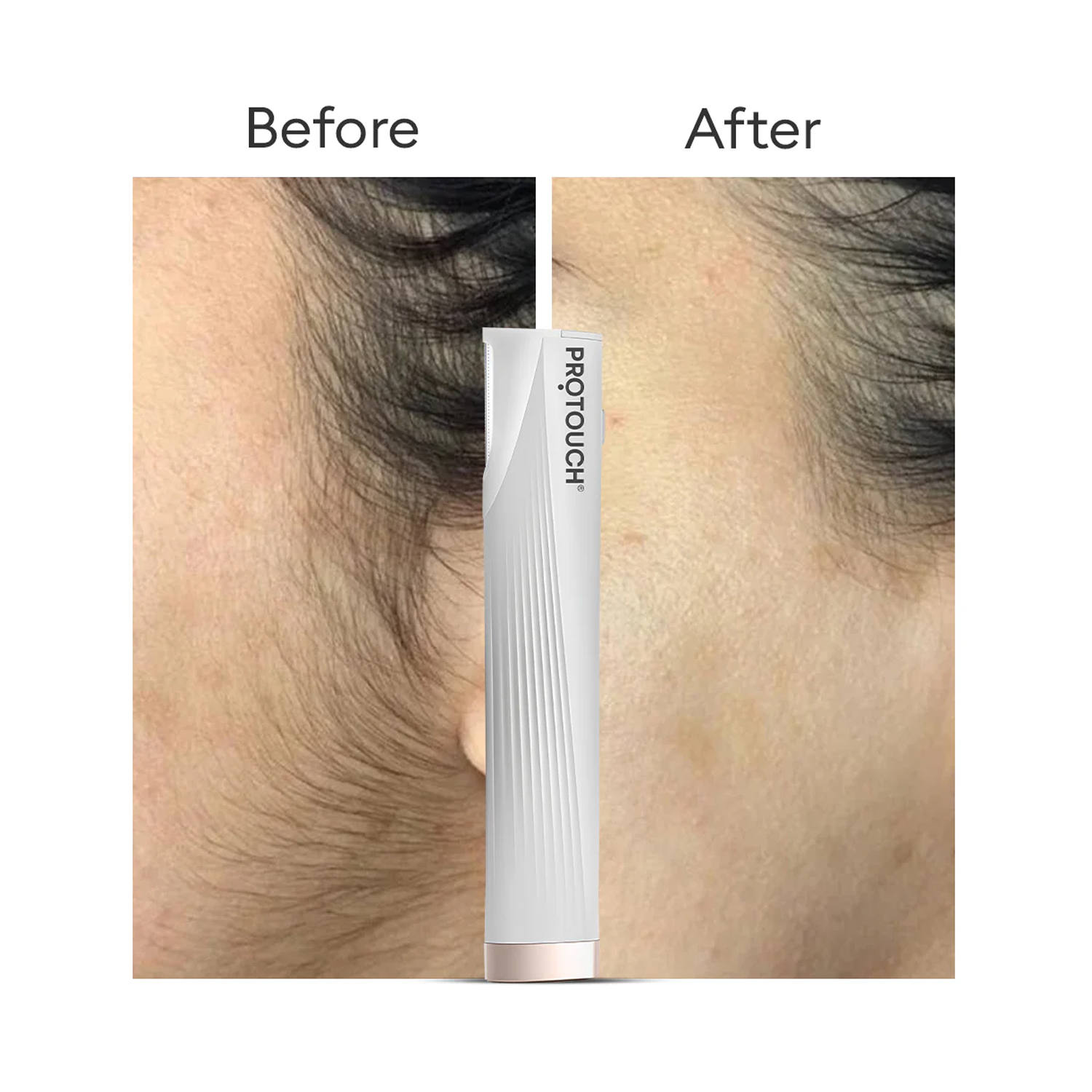 Derma-planing-device-5