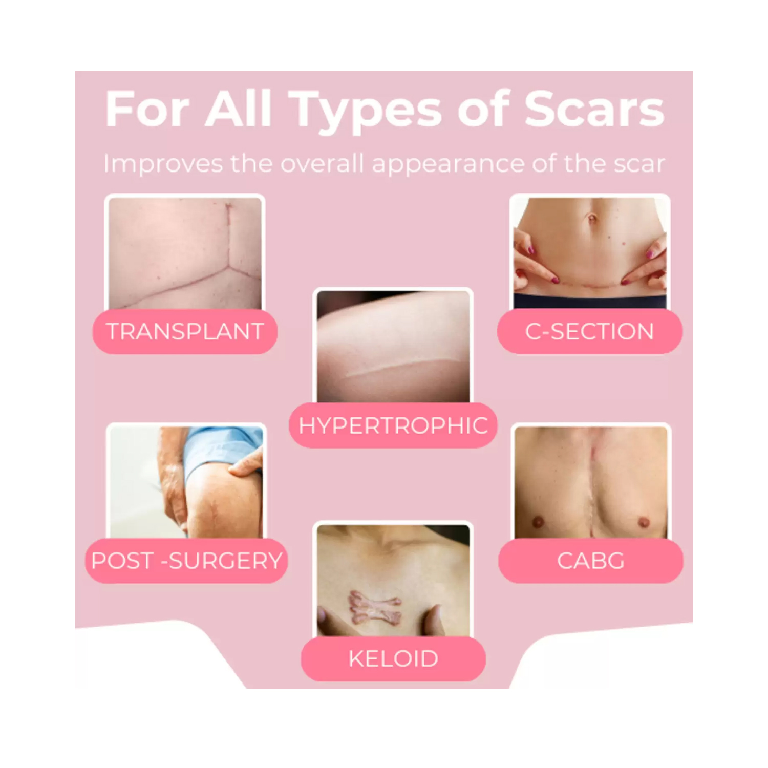 SCARXGEN-SILICONE-GEL-SHEET-6cm-x-12cm-3
