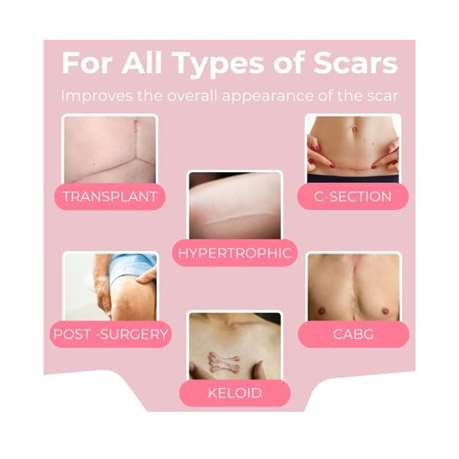 Scarxgen-Silicone-Gel-Sheet-10cm-x-10cm-3