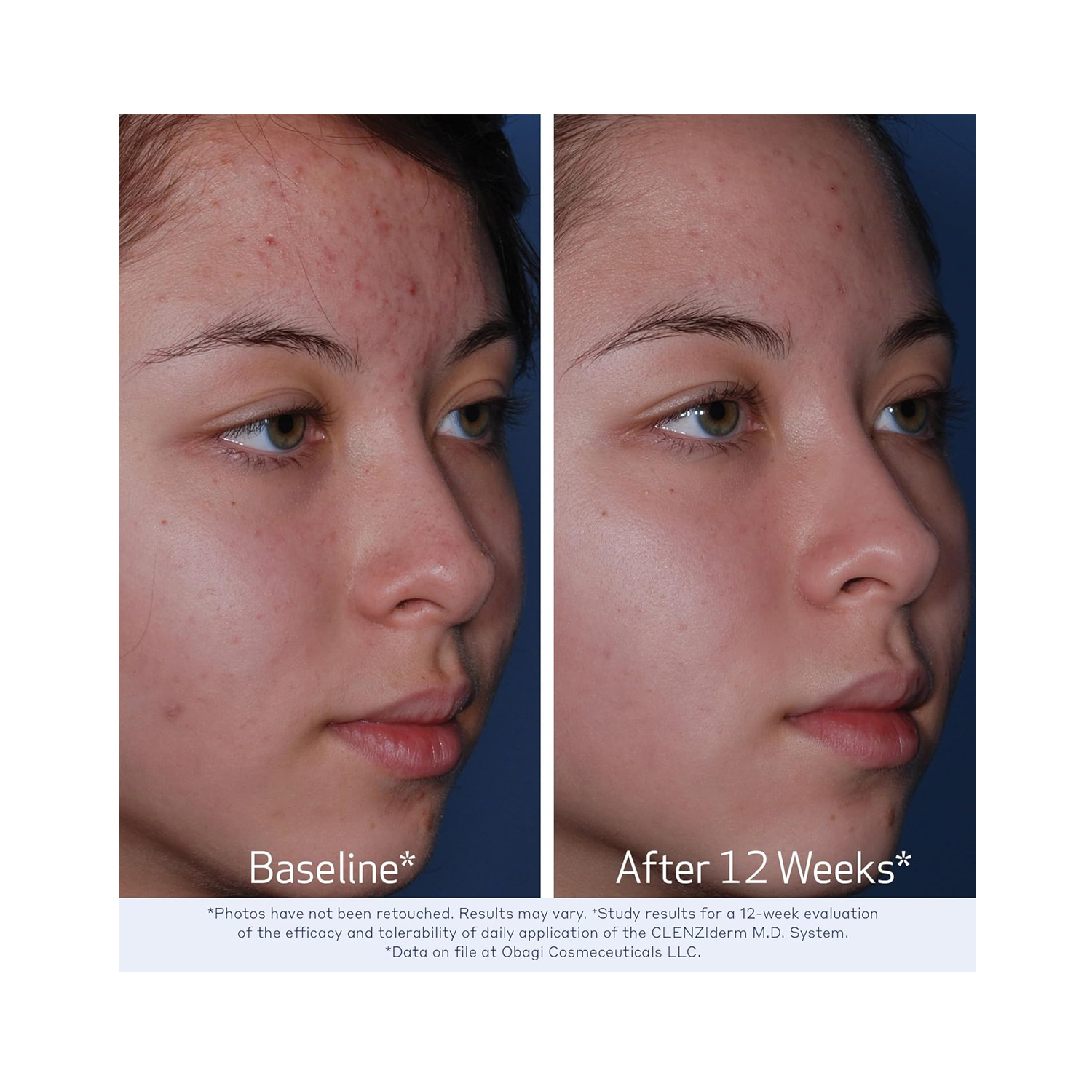 Obagi-CLENZIderm-3
